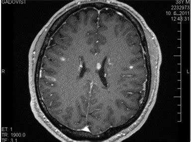 MRI mozgu s vyznačenými léziami