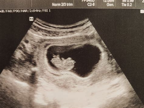 Schéma Dopplerovho ultrazvuku