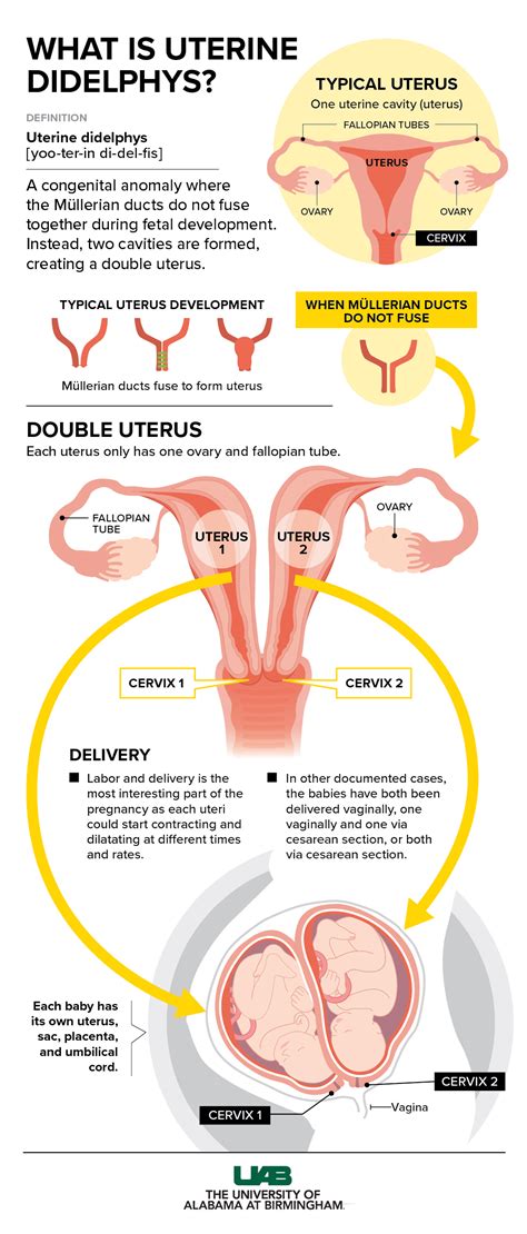 Schéma maternice pri diagnóze uterus didelphys