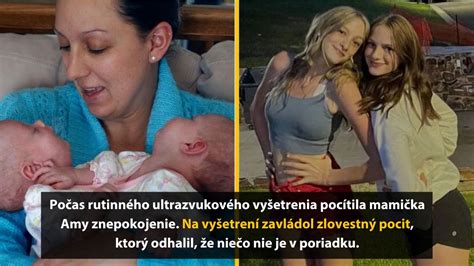 Ilustrácia ultrazvukového vyšetrenia dvojčiat