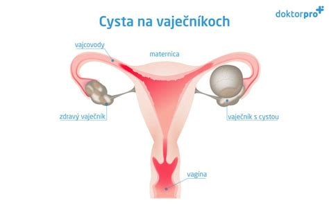 Ilustrácia ženského reprodukčného systému