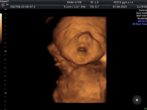 ultrazvuk nenarodeného dieťaťa