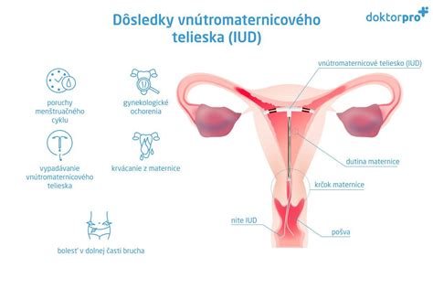 Ilustrácia vnútromaternicového telieska Mirena