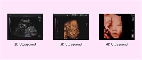 porovnanie 2D, 3D a 4D ultrazvukového zobrazenia