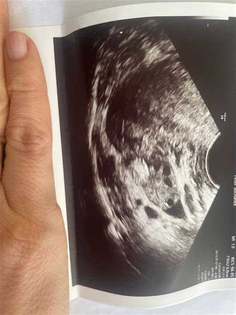 Štruktúra vaječníka