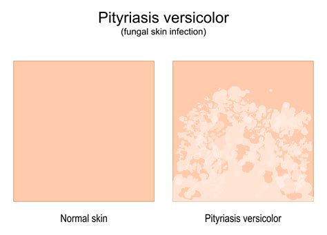 Porovnanie normálnej a membránovej placenty