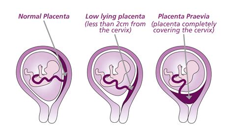 Grafické znázornenie placenta praevia