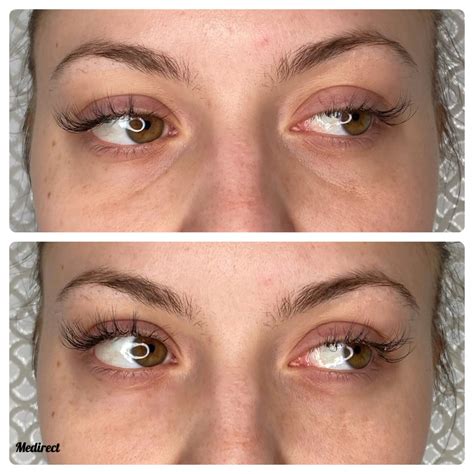 Schéma zobrazujúca rôzne príčiny kruhov pod očami