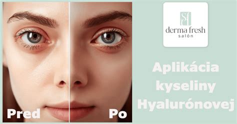 Infografika s odporúčanými potravinami pre redukciu kruhov pod očami