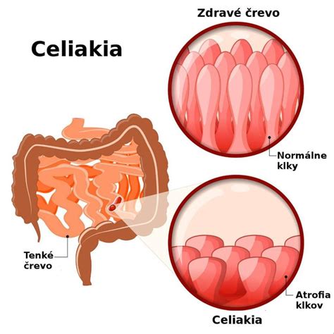 Schematické znázornenie hypoplastického ľavokomorového syndrómu