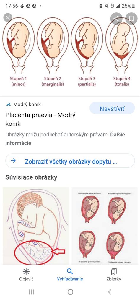Ilustrácia pôrodných ciest