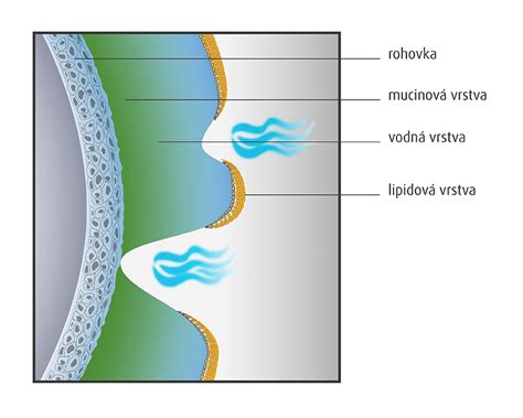 Ilustrácia upchatého slzného kanálika