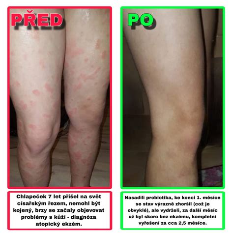 Graf znázorňujúci prepojenie atopického ekzému s astmou a alergickou nádchou