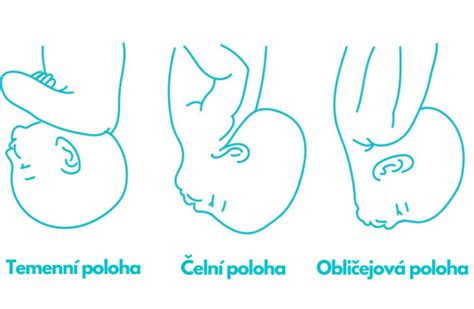 Asymetrická poloha hlavičky novorodenca