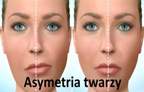 Asymetria tváre dieťaťa