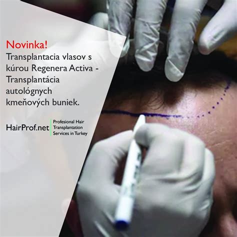 Proces transplantácie vlasov