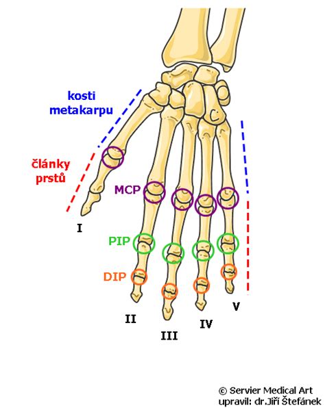Ruka s označenými symptómami skákavého prsta