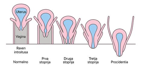 Ilustrácia maternice s krčkom