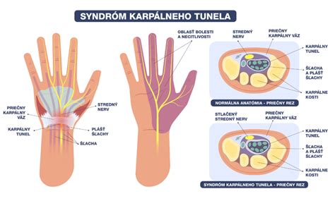 Infografika zobrazujúca príznaky spontánneho potratu