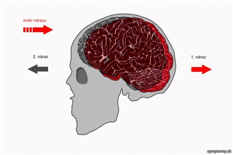 Ilustrácia mozgu v lebke pri otrasu