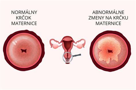 Schematické znázornenie zmien krčka maternice počas cyklu