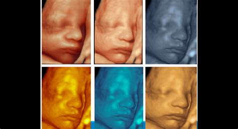 Schematické zobrazenie 3D ultrazvuku mozgu plodu