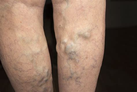 Zväčšený pohľad na kŕčové žily na nohe