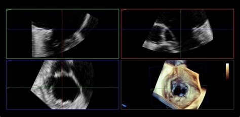 Základné zobrazenie srdca pomocou ultrazvuku