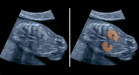 ultrazvuk plodu v prvom trimestri