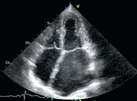 Echokardiogram srdca