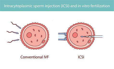 Schematické znázornenie procesu IVF