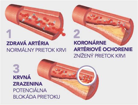 schematické znázornenie upchatia cievy krvnou zrazeninou