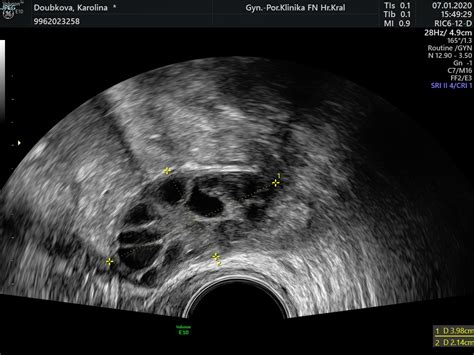 Ultrazvukové zobrazenie cysty na vaječníku