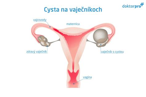 Infografika zobrazujúca rôzne typy cýst na vaječníkoch