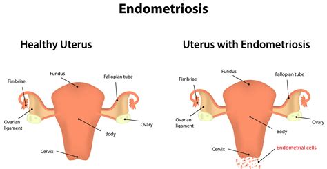 Štruktúra endometria