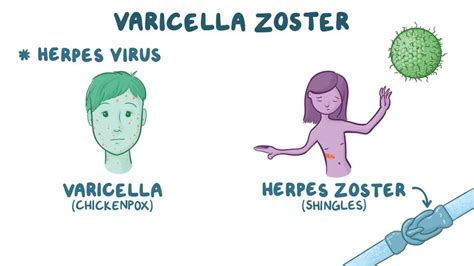 Infografika o prenose vírusu varicella-zoster