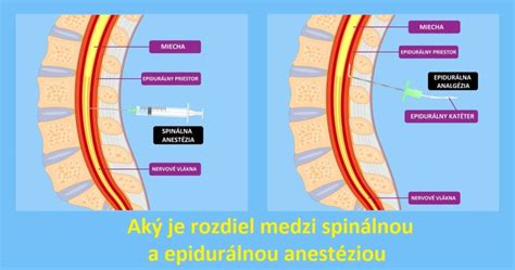 Infografika rôznych typov regionálnej anestézie pri pôrode
