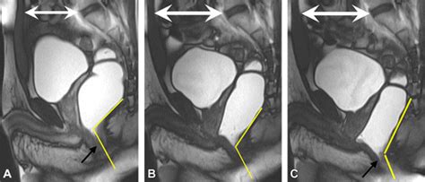 MRI panvy zobrazujúce anomáliu maternice