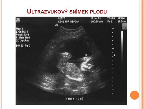 Ultrazvukový snímok plodu v maternici.