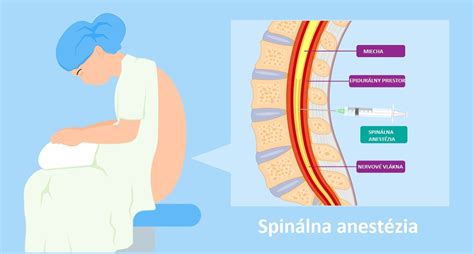 Infografika typov anestézie pri cisárskom reze