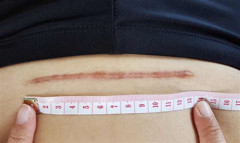 Jazva po cisárskom reze