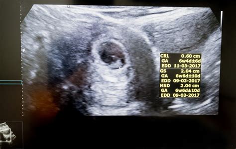 Ultrazvukový snímok embrya v 7. týždni tehotenstva