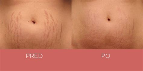 Strie na bruchu v tehotenstve