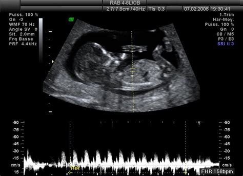 3D ultrazvuk plodu v 12. týždni