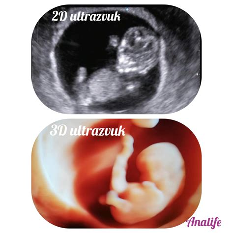Porovnanie 2D, 3D a 4D ultrazvuku