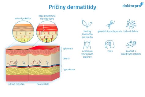 porovnanie periorálnej dermatitídy a rosacey