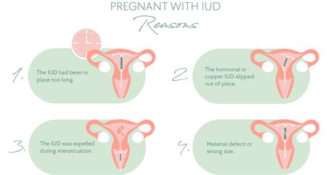 Porovnanie hormonálnych a nehormonálnych IUD