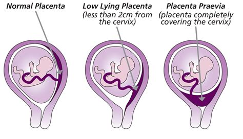 Porovnanie normálnej polohy placenty a placenta praevia