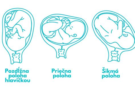 Schematické znázornenie umiestnenia placenty v maternici