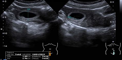 Ultrazvukové zobrazenie placenty na prednej stene